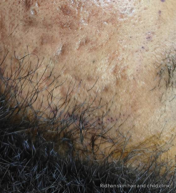 Acne scarring after treatment