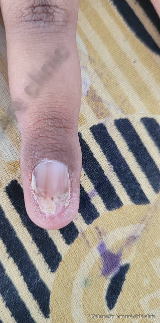 Nail infection after treatment
