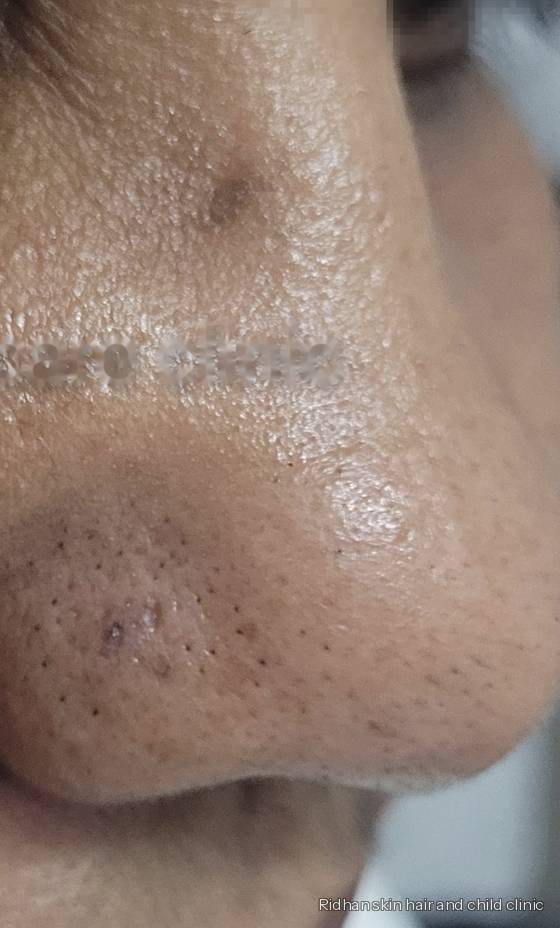 Wart removal after treatment