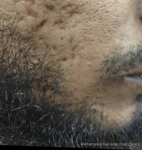 Acne scarring before treatment
