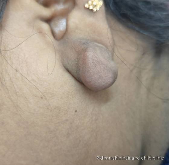 Ear lobe keloid before treatment