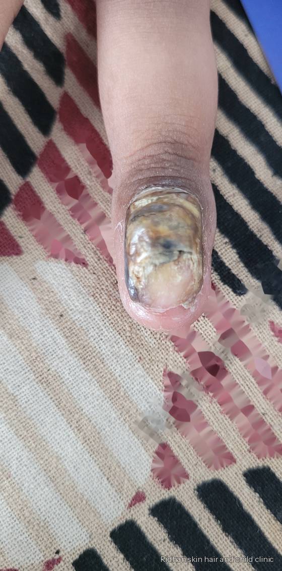 Nail infection before treatment