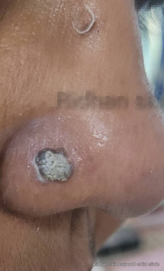 Wart removal before treatment