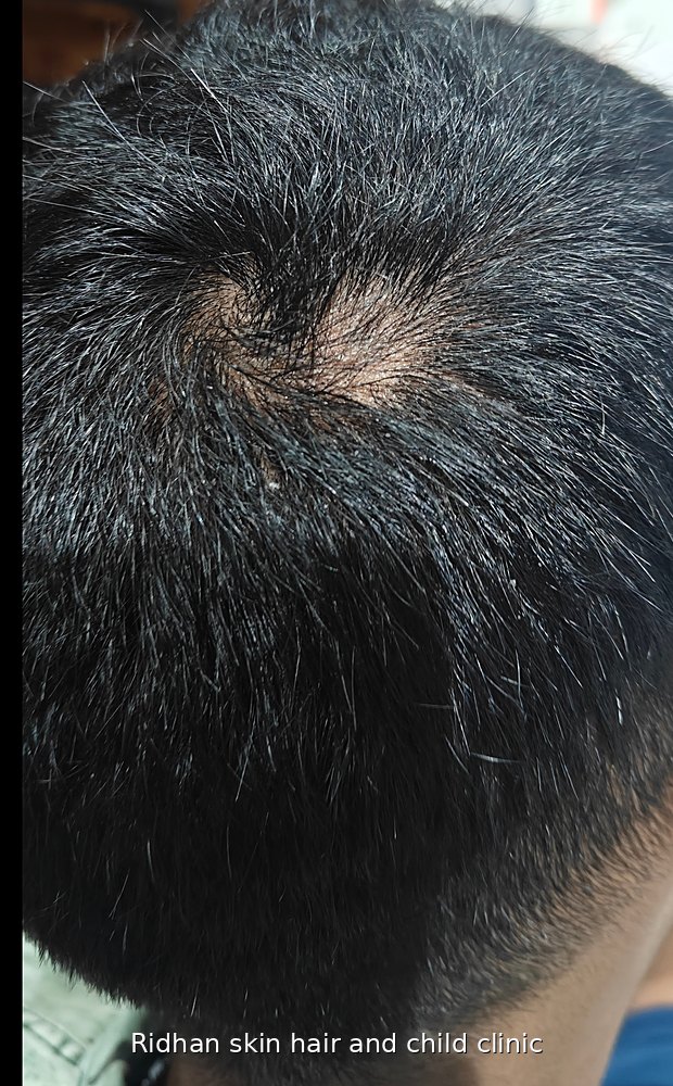 Alopecia areata before treatment